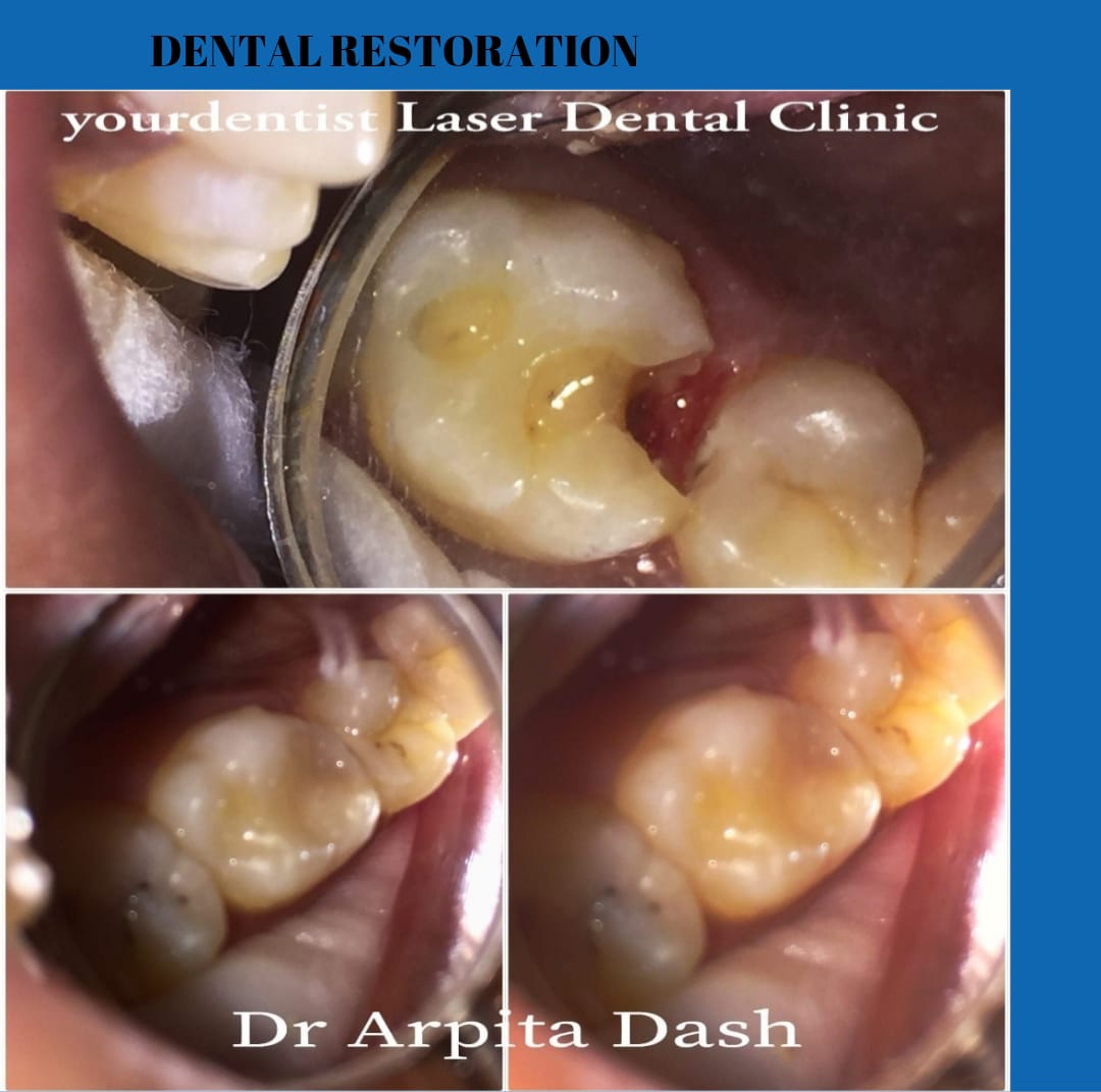 Dental Restoration result at YourDentist Laser Dental Clinic Bhubaneswar