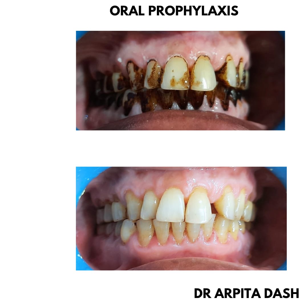 Oral Prophylaxis result at YourDentist Laser Dental Clinic Bhubaneswar