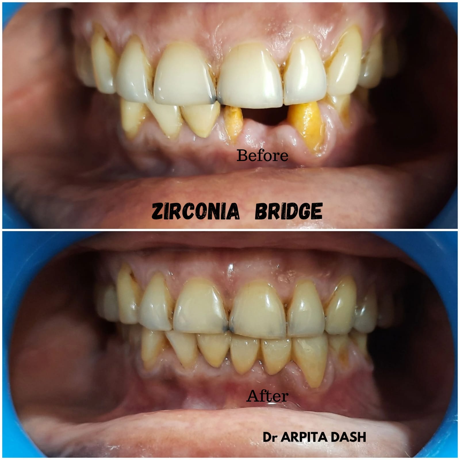 Zirconia Bridge treatment result at YourDentist Laser Dental Clinic Bhubaneswar