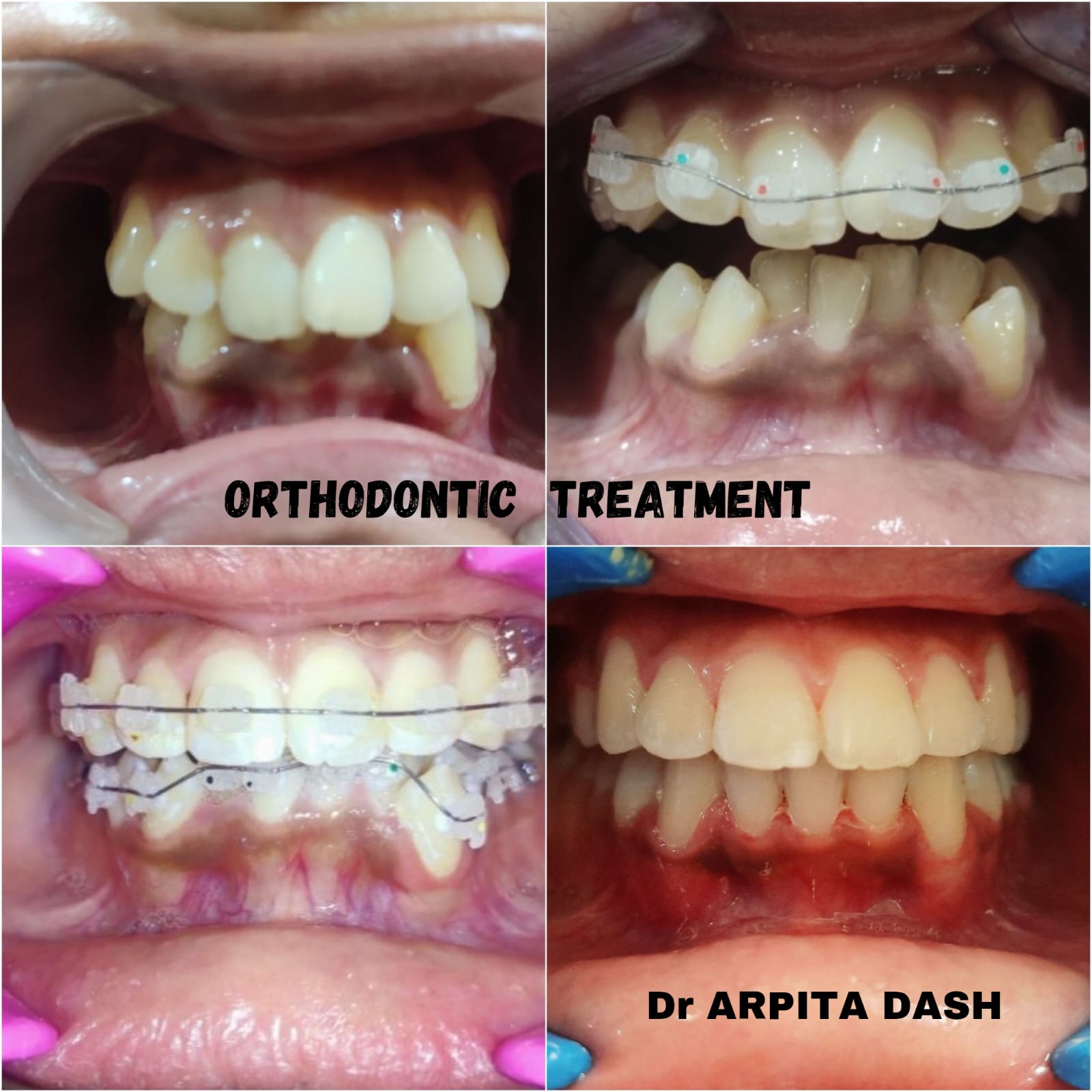 Orthodontic Treatment result at YourDentist Laser Dental Clinic Bhubaneswar