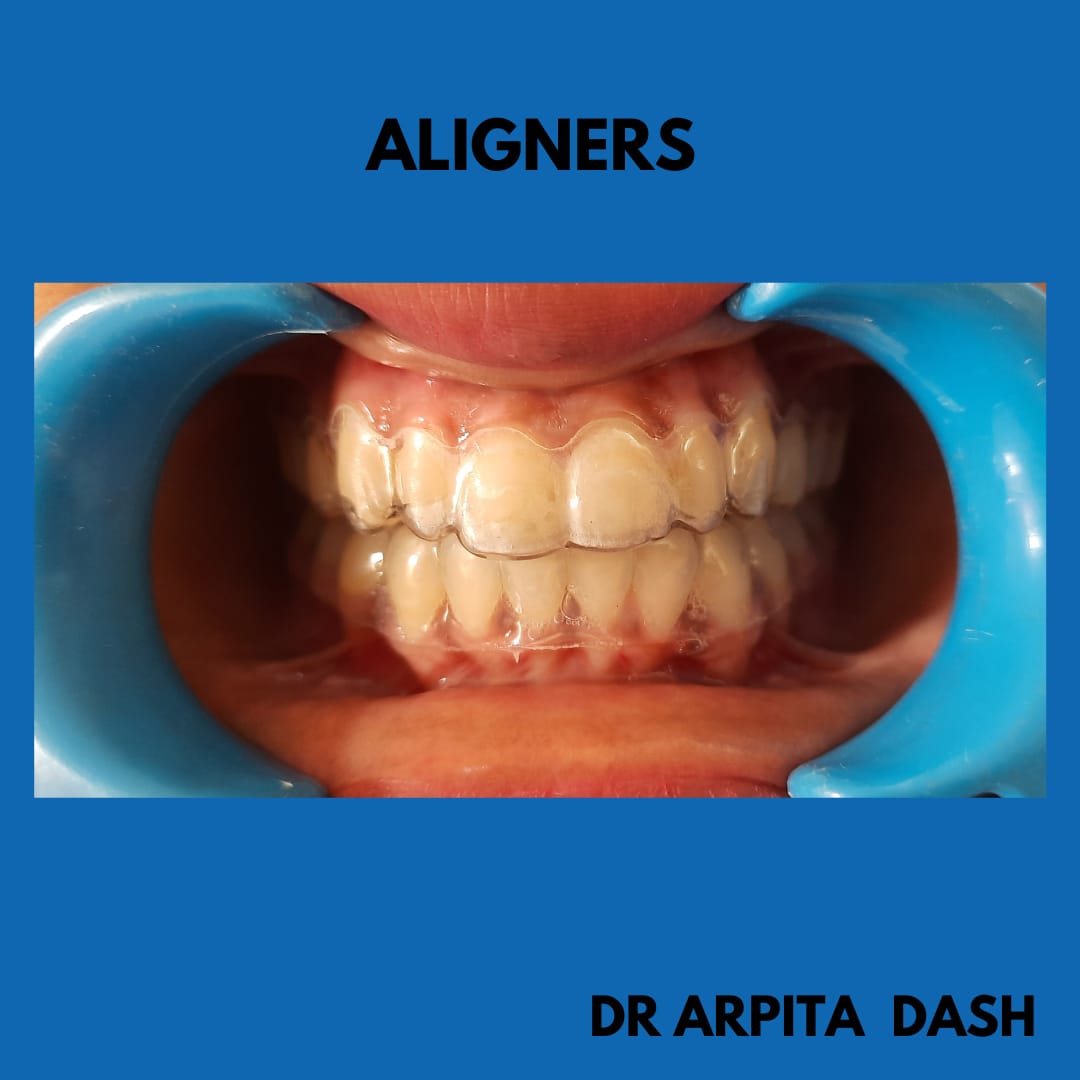 Aligners treatment result at YourDentist Laser Dental Clinic Bhubaneswar